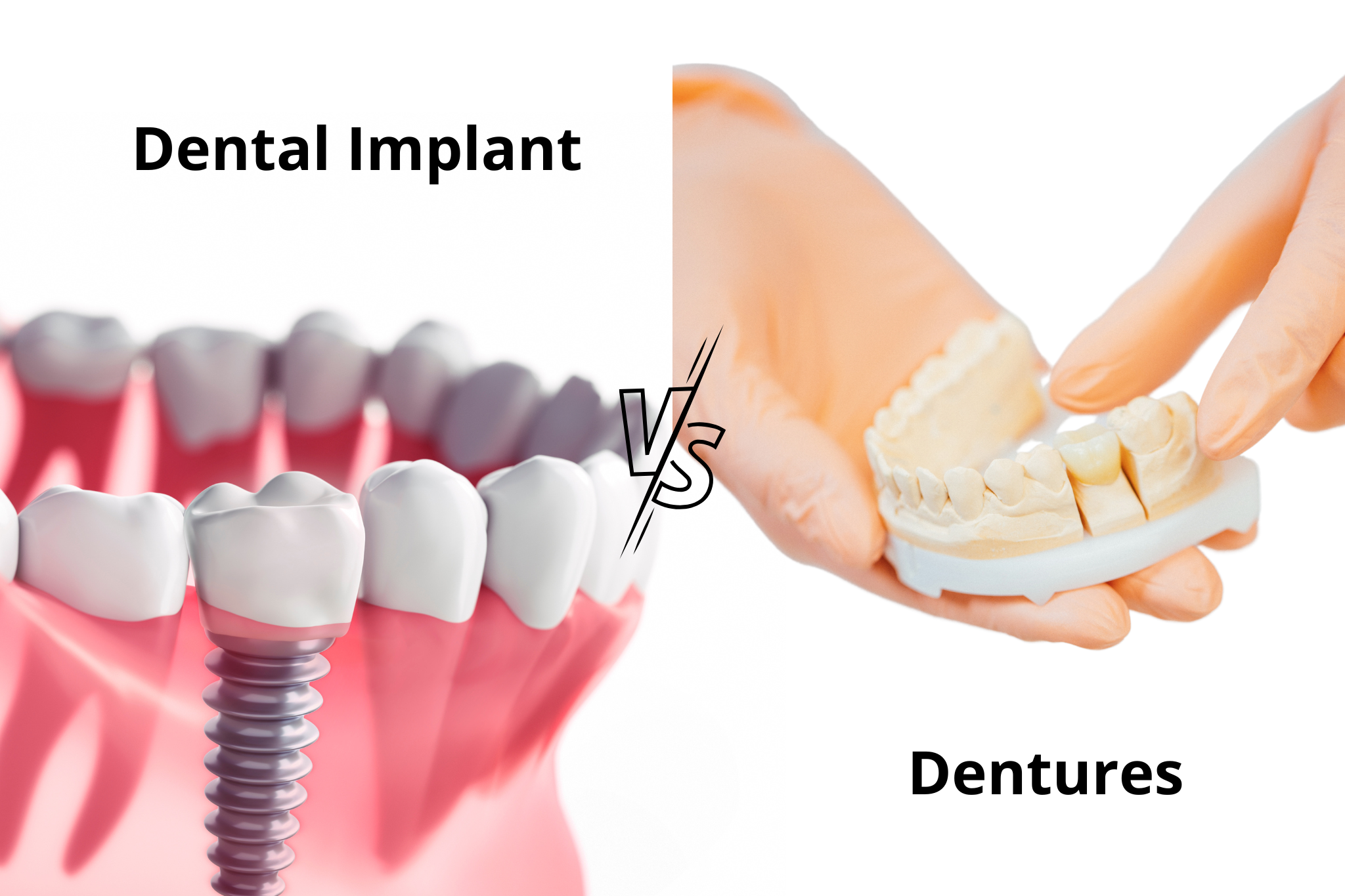 Read more about the article Dental Implants vs. Dentures: Which is Right for You?
